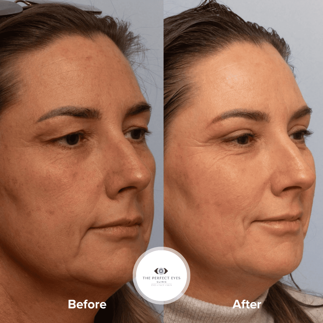 Upper blepharoplasty before and after, case 12, by Dr Sabrina Shah-Desai