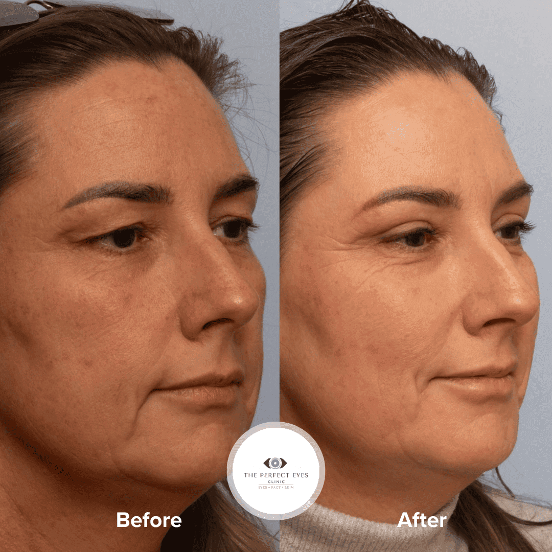 Upper blepharoplasty before and after, case 12, by Dr Sabrina Shah-Desai