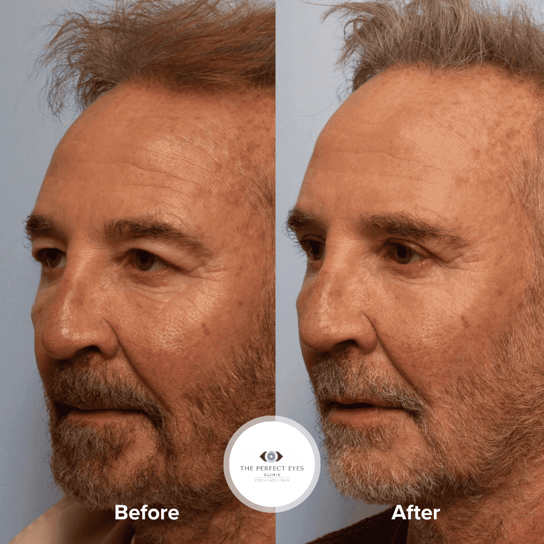 Ptosis surgery before and after, case 17, by Dr Sabrina Shah-Desai