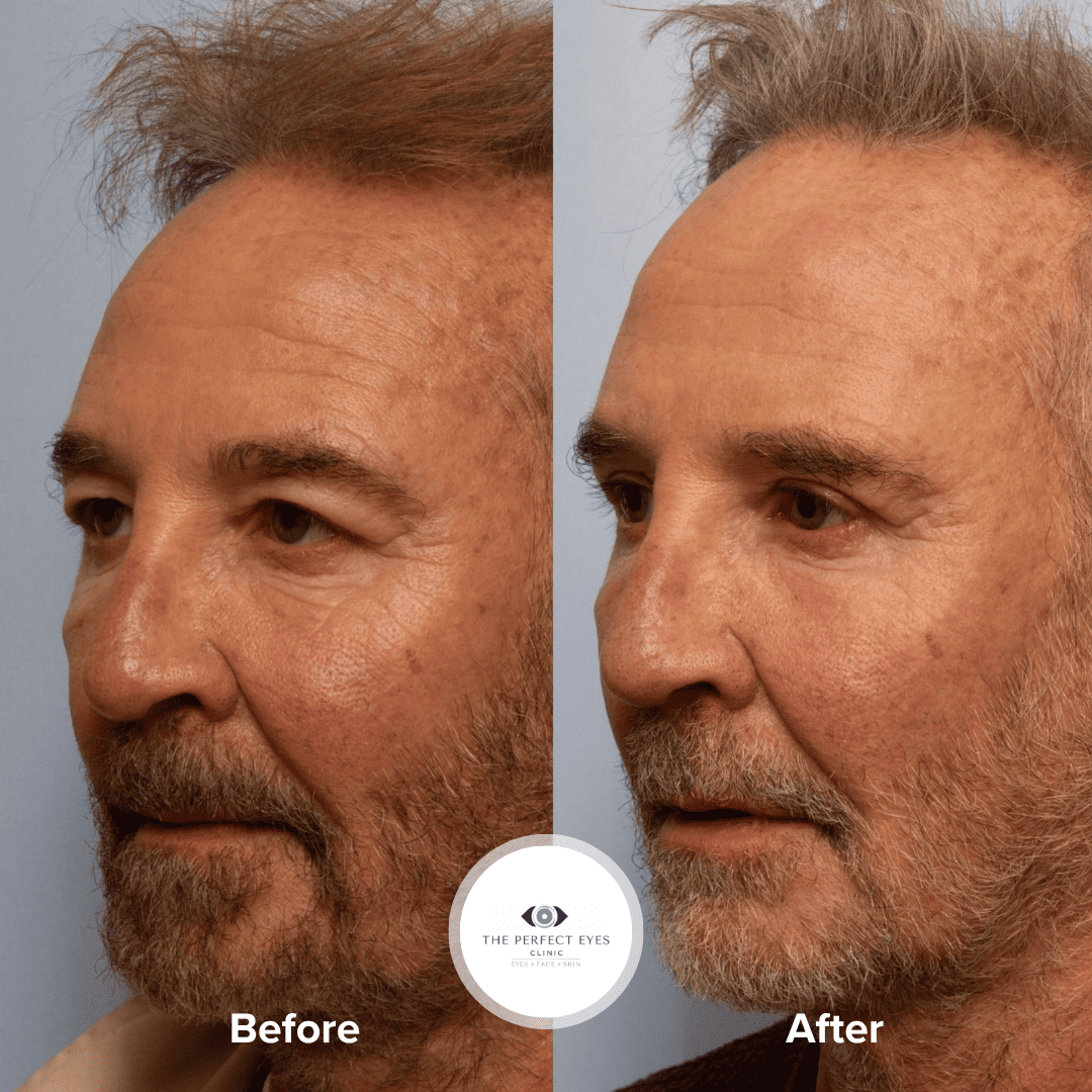 Ptosis surgery before and after, case 17, by Dr Sabrina Shah-Desai