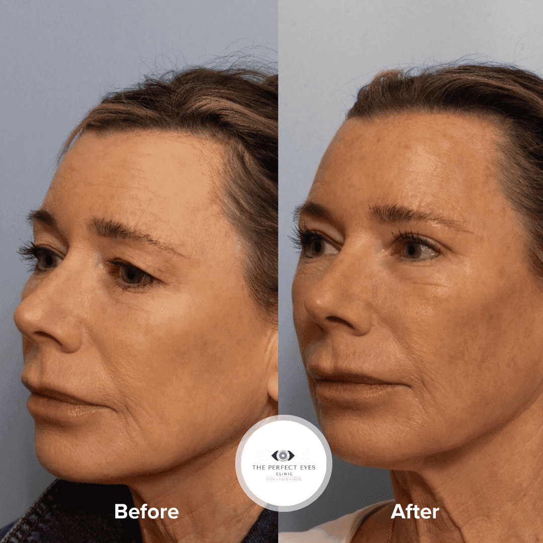 Upper Blepharoplasty before and after, a patient of Dr Sabrina Shah-Desai