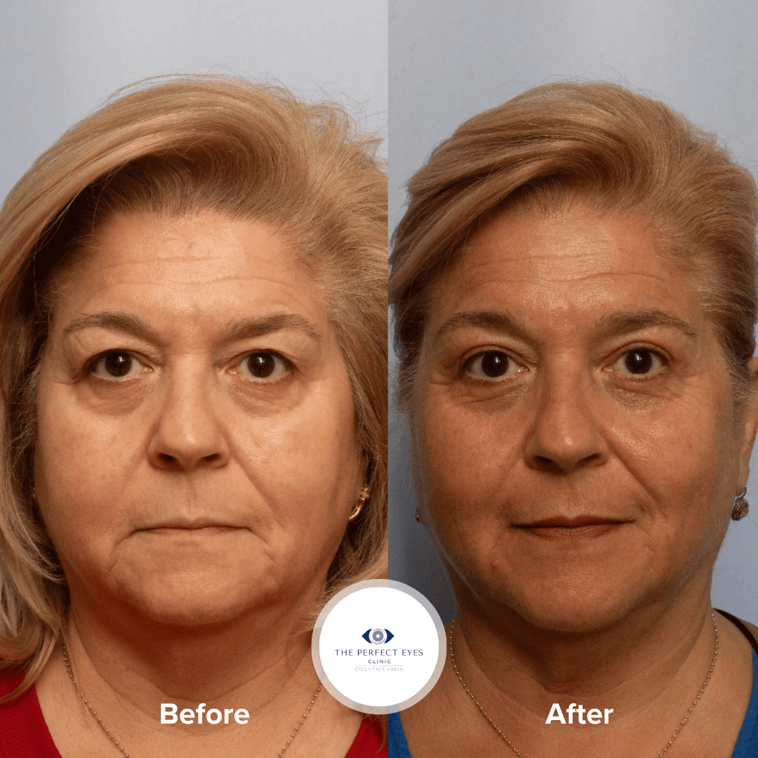 Upper Blepharoplasty before and after, a patient of Dr Sabrina Shah-Desai