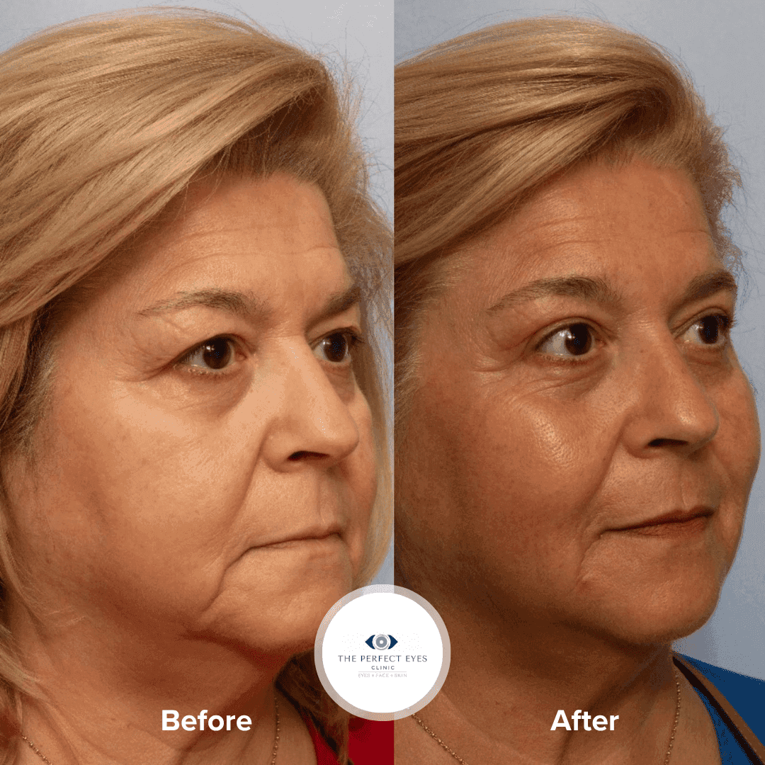 Upper blepharoplasty before and after, case 14, by Dr Sabrina Shah-Desai