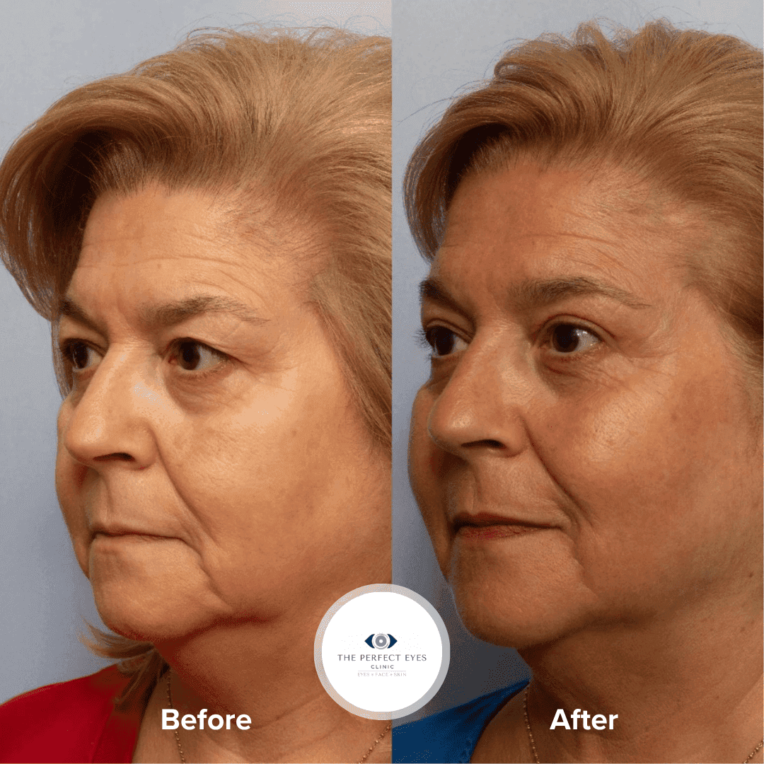Upper blepharoplasty before and after, case 15, by Dr Sabrina Shah-Desai