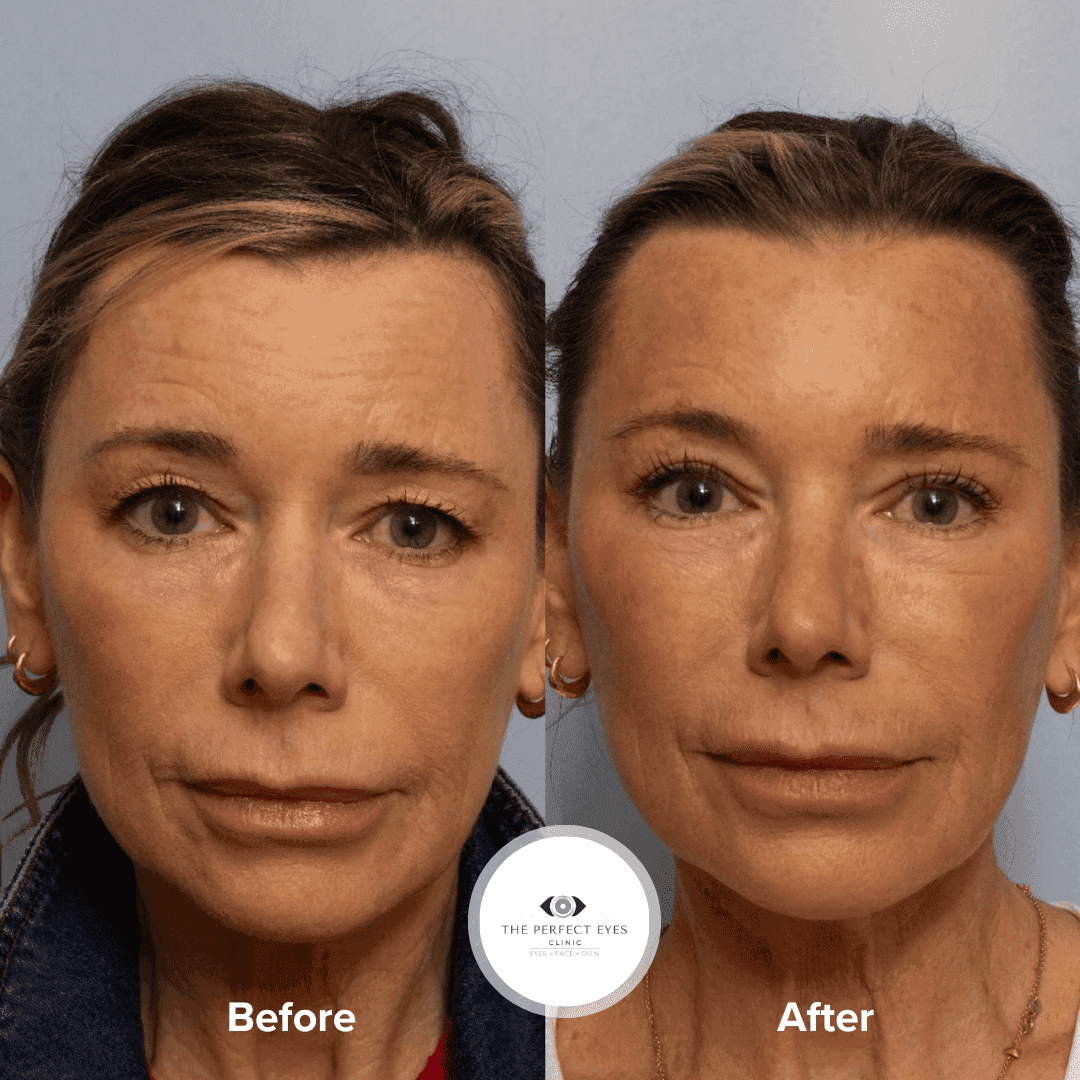 Blepharoplasty before and after, a patient of Dr Sabrina Shah-Desai