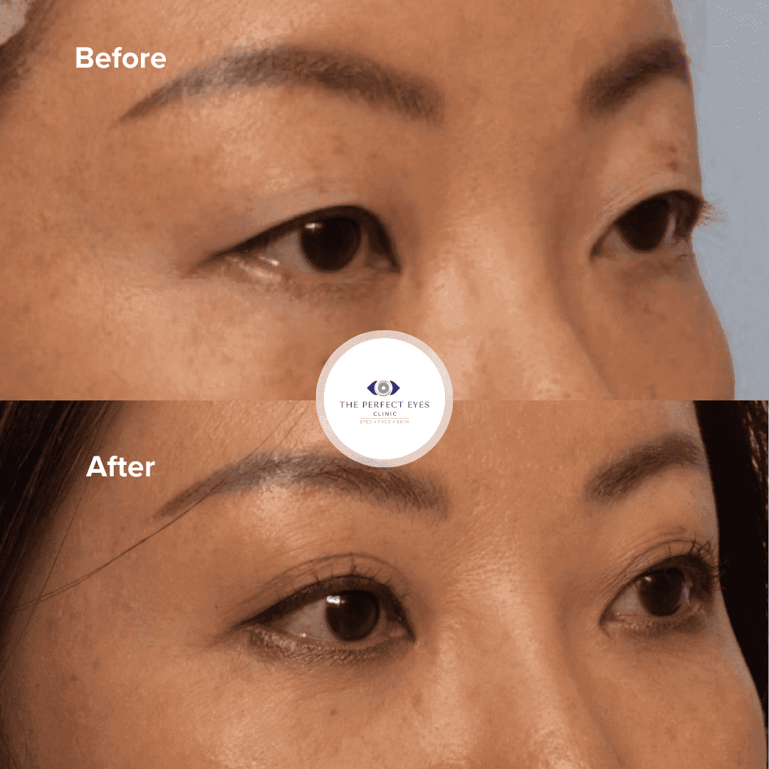 Double Eyelid Surgery before and after - case 3