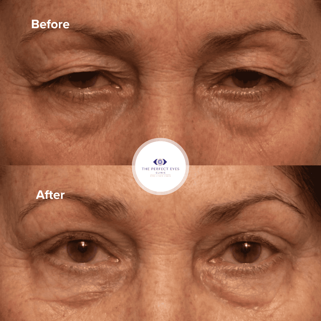 Ptosis surgery before and after, case 18, by Dr Sabrina Shah-Desai