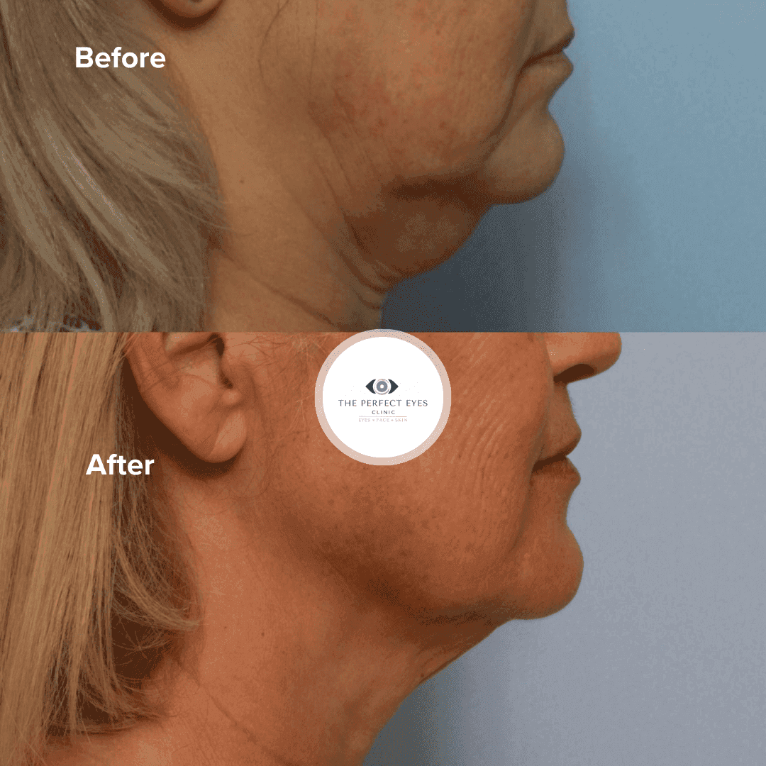 Endolift - Revolutionary Minimally Invasive Jawline Lift before and after, a patient of Dr Sabrina Shah-Desai