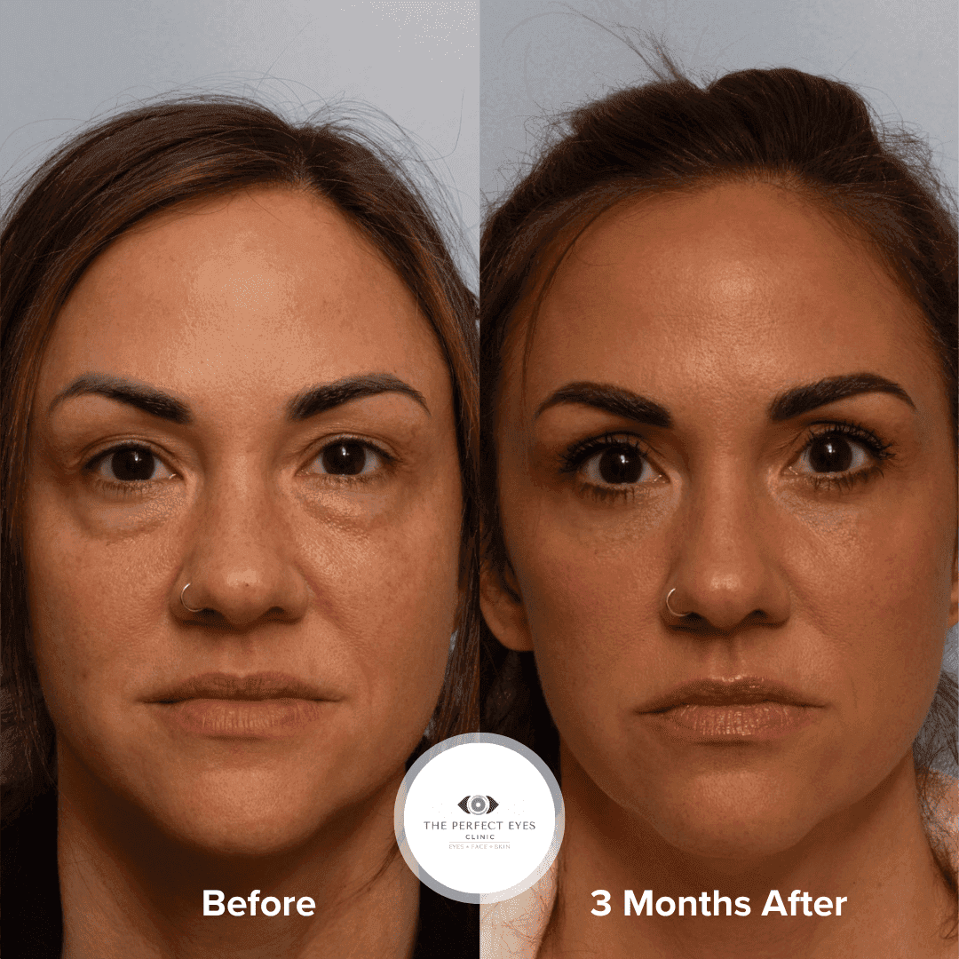 Lower blepharoplasty before and after, case 27, by Dr Sabrina Shah-Desai