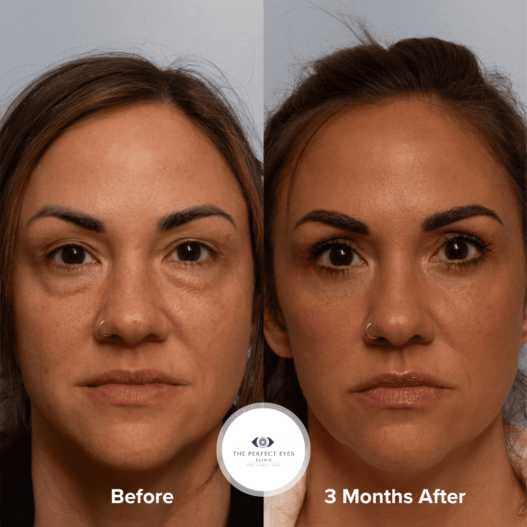 Upper and Lower Eyelid Blepharoplasty before and after, a patient of Dr Sabrina Shah-Desai