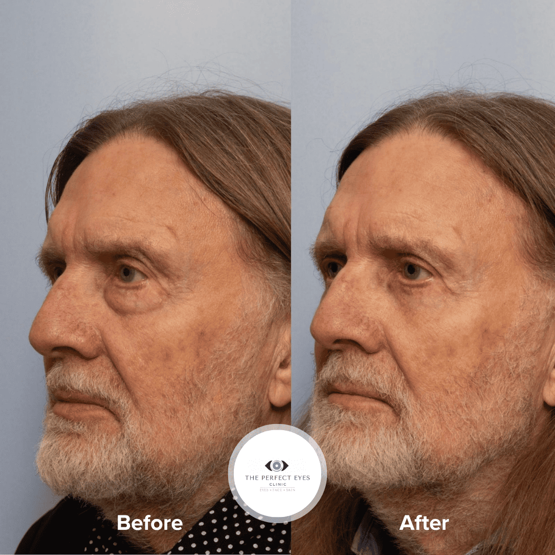 Lower Blepharoplasty before and after, a patient of Dr Sabrina Shah-Desai