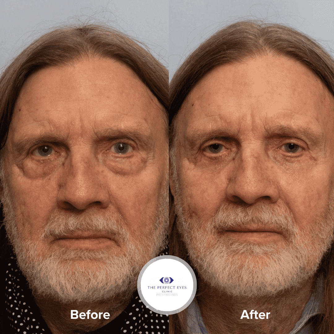 Lower Eye Bag Removal Blepharoplasty before and after, a patient of Dr Sabrina Shah-Desai