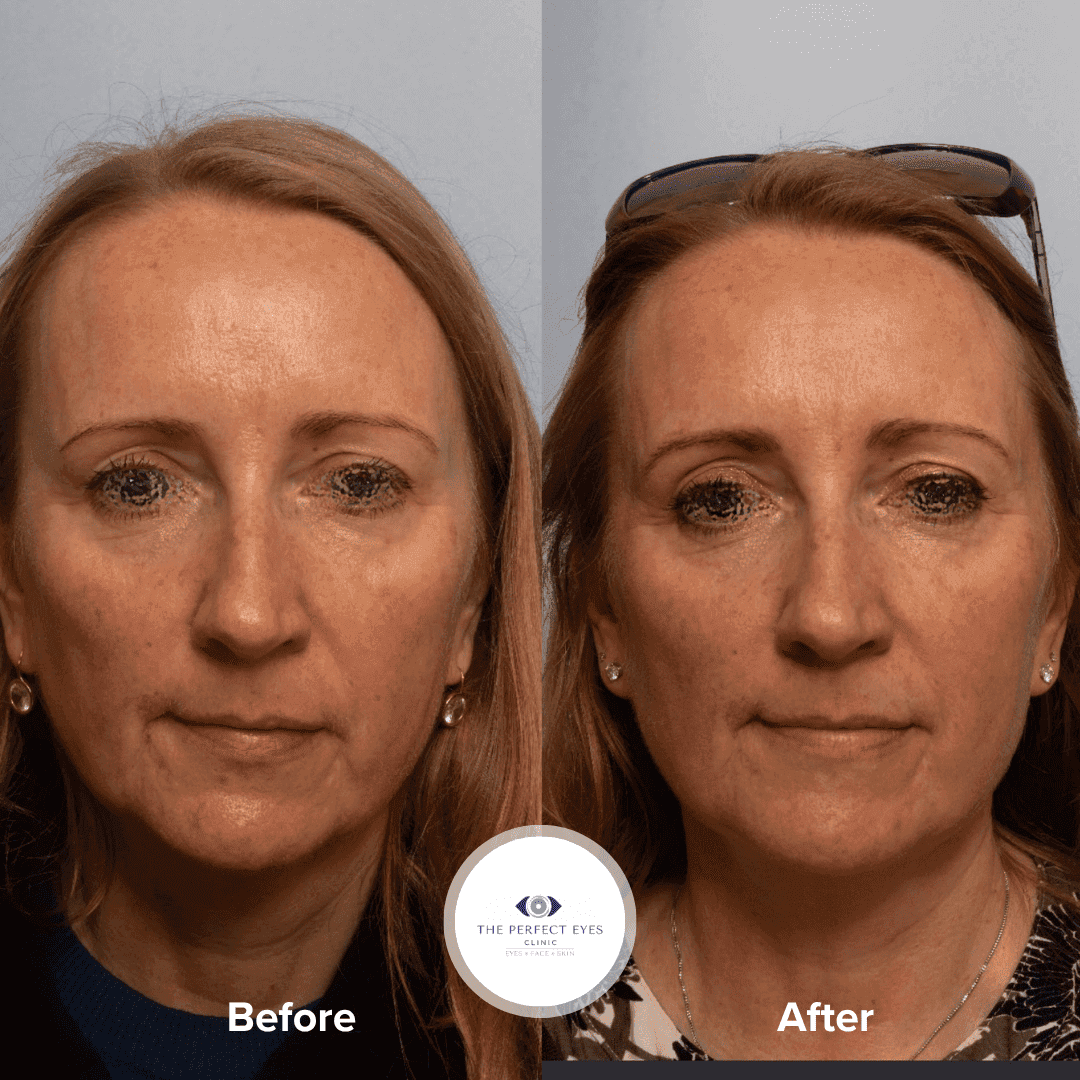 Sofwave™ before and after, a patient of Dr Sabrina Shah-Desai