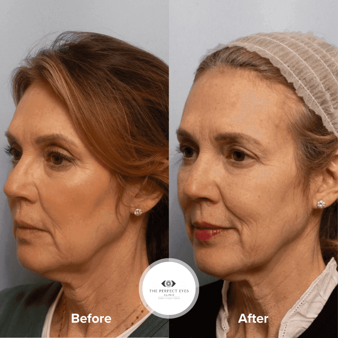 UltraClear laser before and after, case 11, by Dr Sabrina Shah-Desai