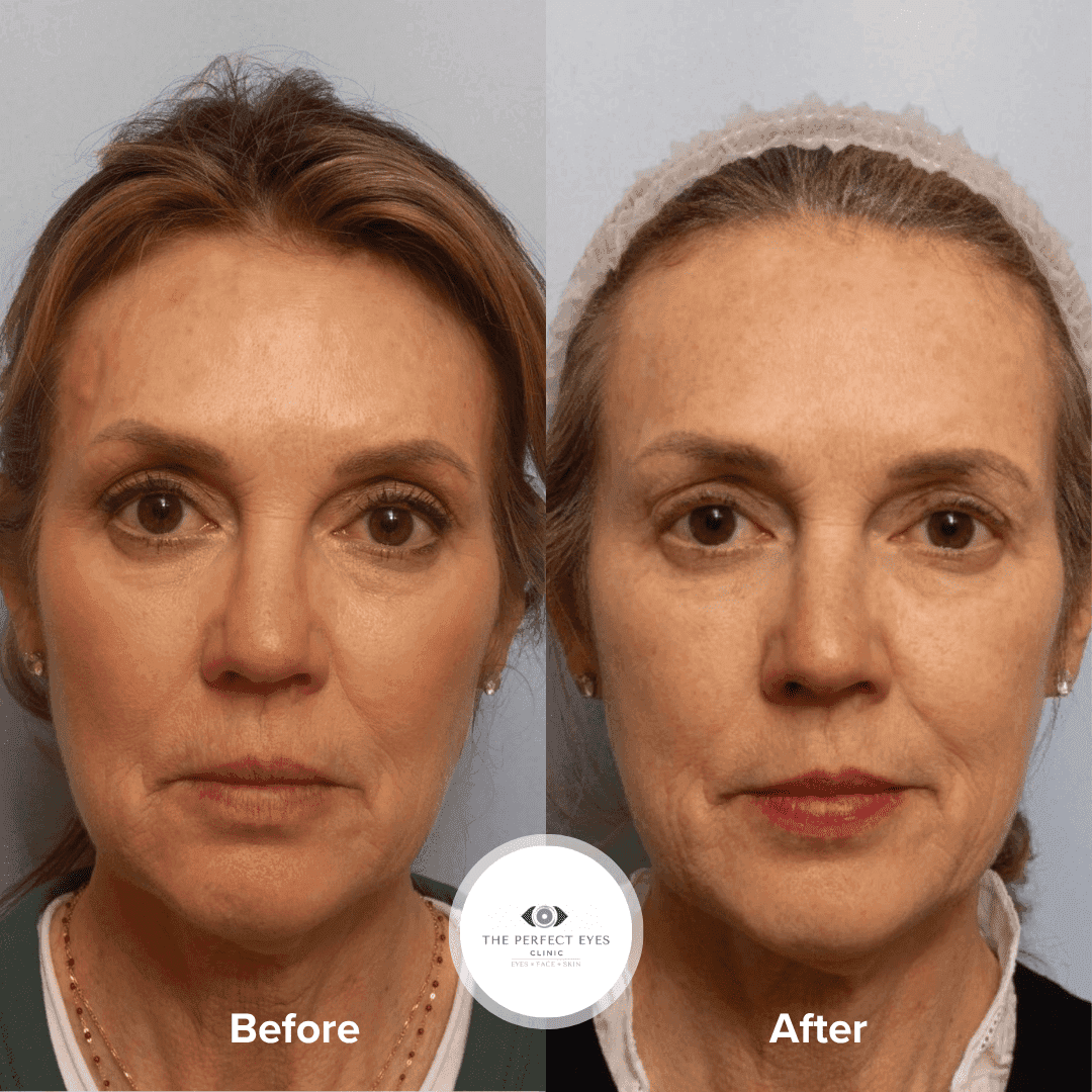 UltraClear Laser before and after, a patient of Dr Sabrina Shah-Desai