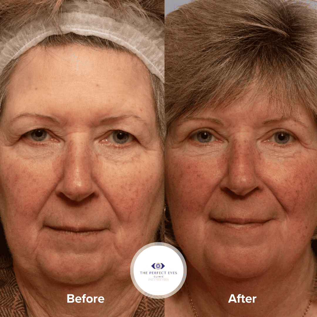 Eyelid Lift Surgery before and after, a patient of Dr Sabrina Shah-Desai