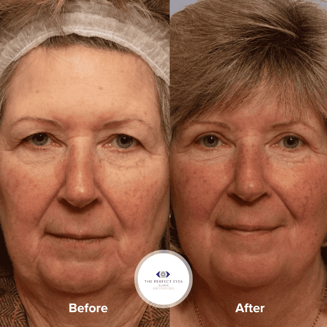 Eyelid Lift Surgery before and after, a patient of Dr Sabrina Shah-Desai