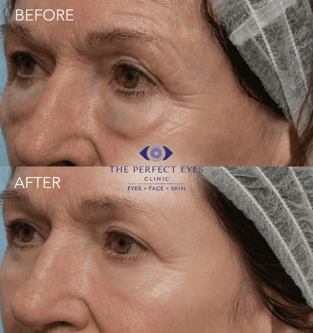 Lower blepharoplasty before and after, case 14, by Dr Sabrina Shah-Desai
