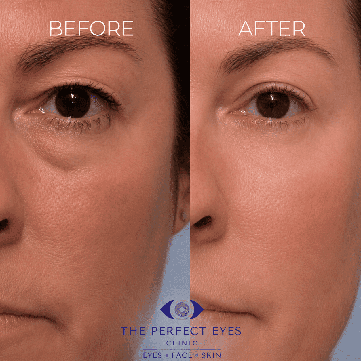 Lower blepharoplasty before and after, case 18, by Dr Sabrina Shah-Desai