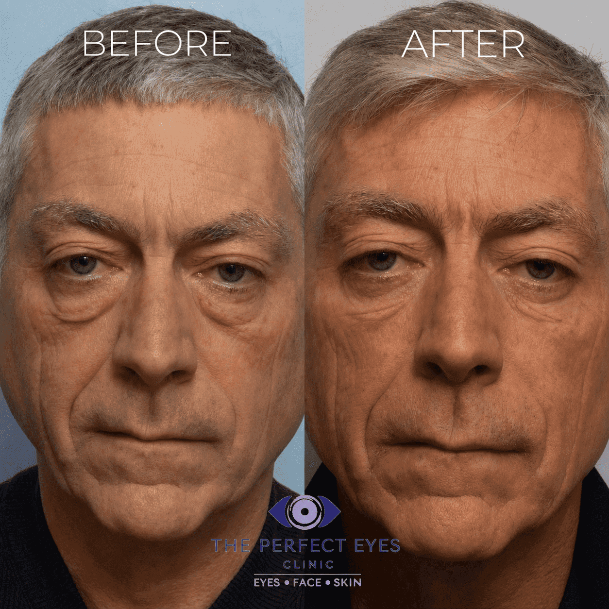 Lower blepharoplasty before and after, case 2, by Dr Sabrina Shah-Desai
