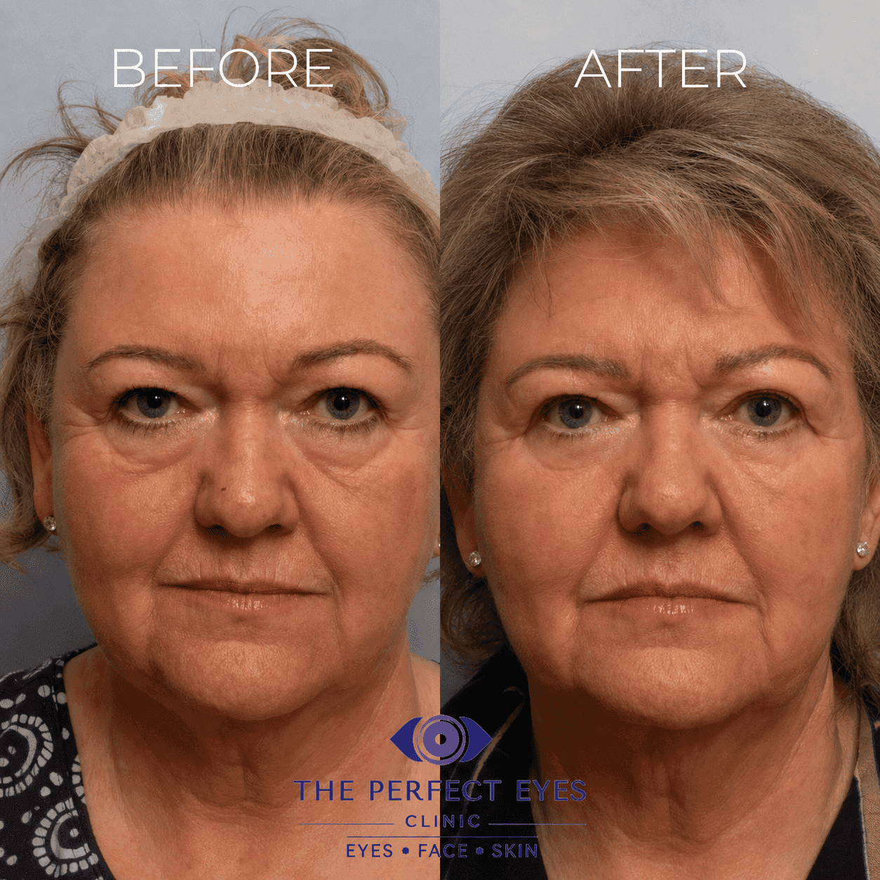 Lower blepharoplasty before and after, case 23, by Dr Sabrina Shah-Desai