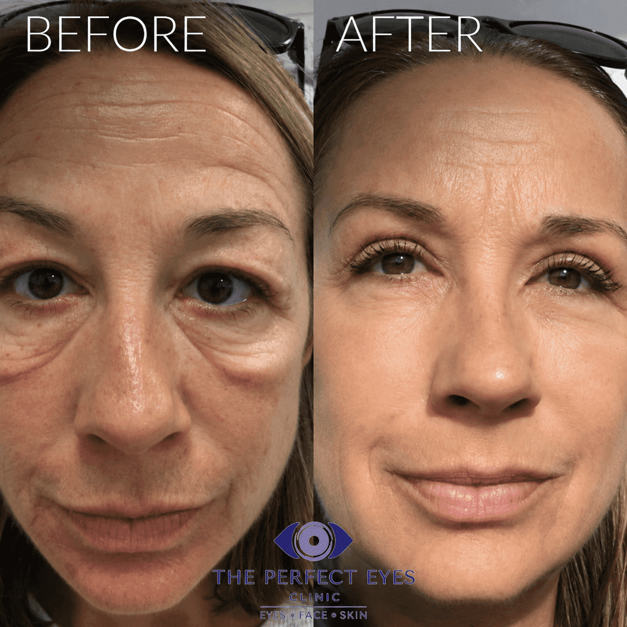 Lower blepharoplasty before and after, case 8, by Dr Sabrina Shah-Desai