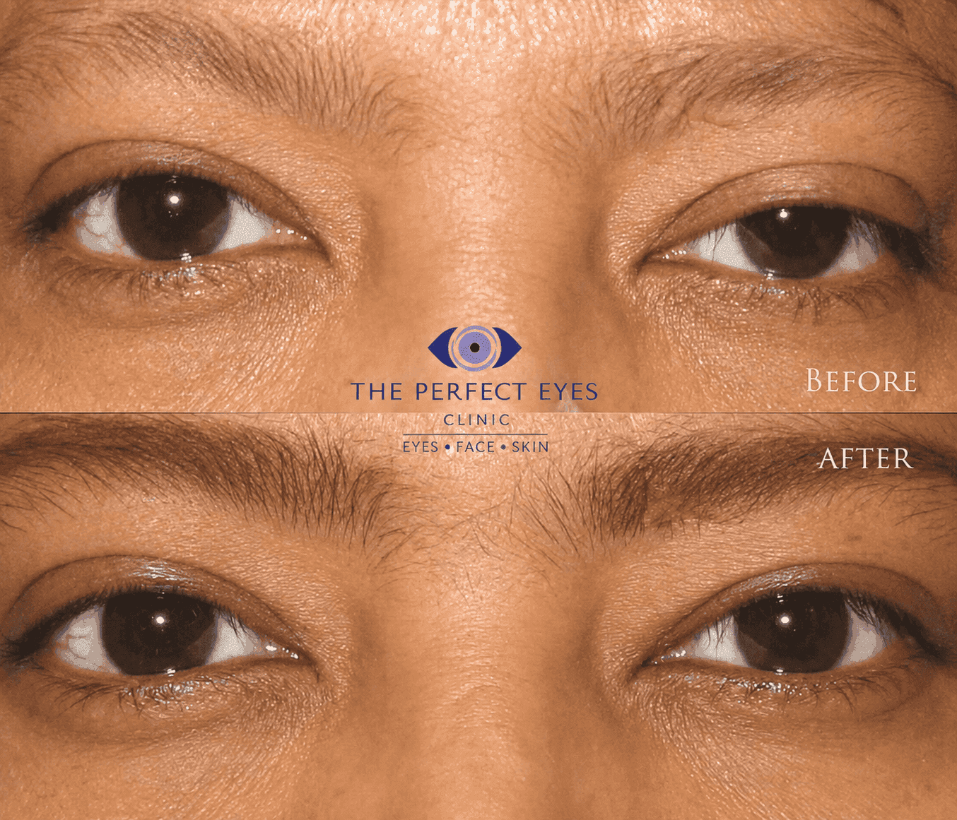 Ptosis surgery before and after, case 10, by Dr Sabrina Shah-Desai