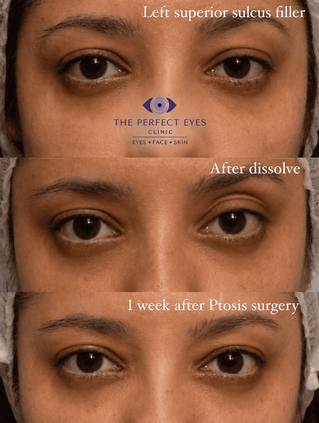Ptosis surgery before and after, case 11, by Dr Sabrina Shah-Desai