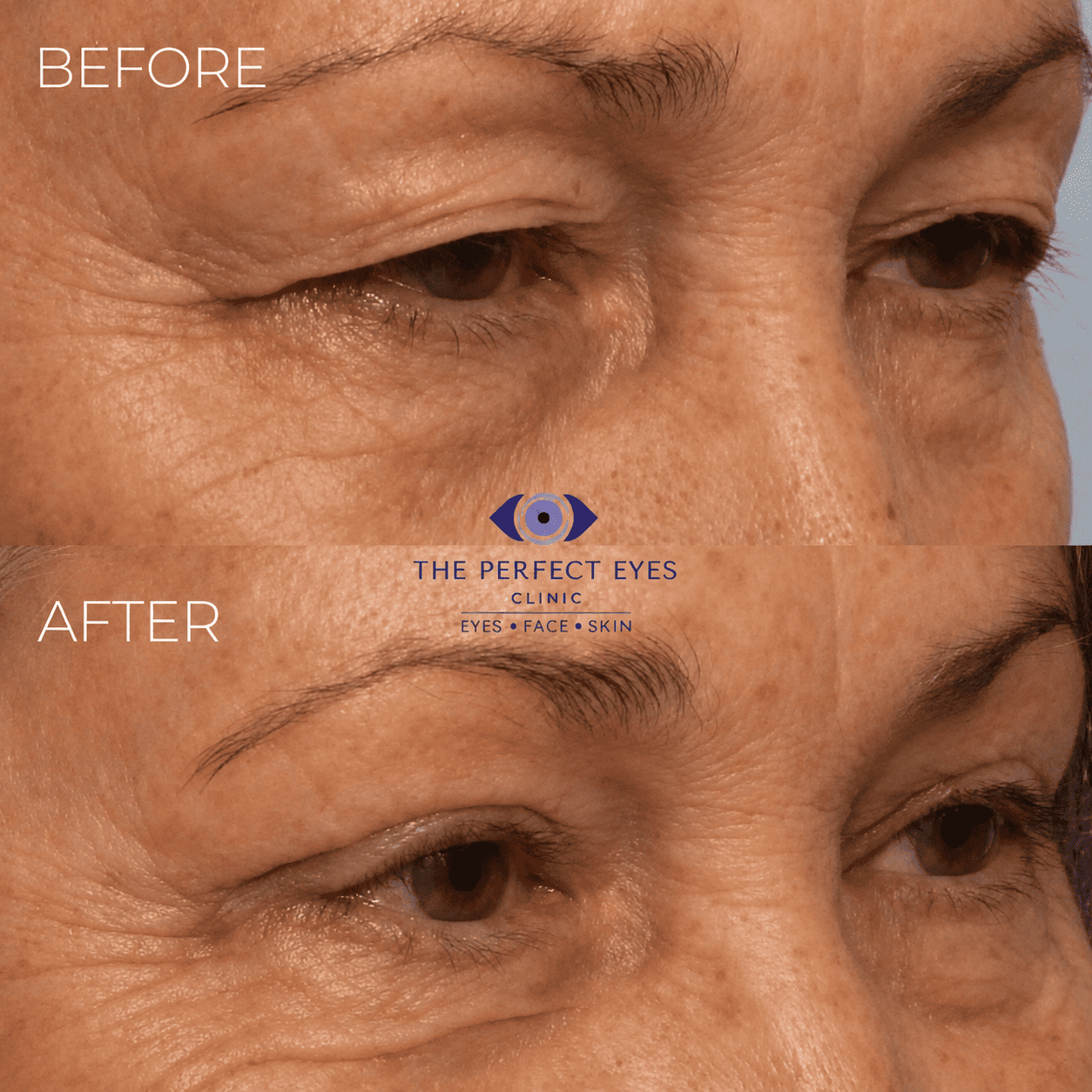 Ptosis surgery before and after, case 14, by Dr Sabrina Shah-Desai