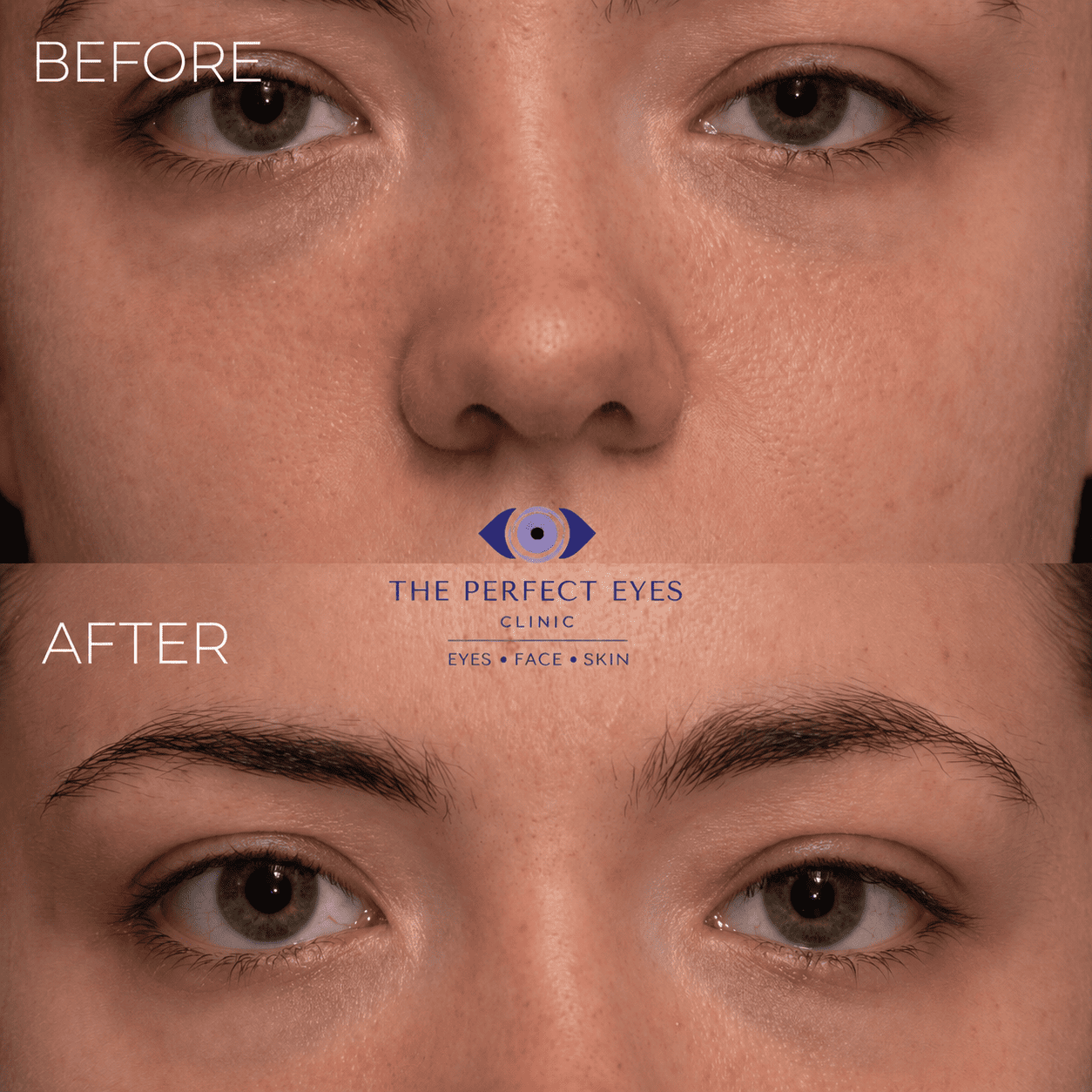 Ptosis surgery before and after, case 15, by Dr Sabrina Shah-Desai