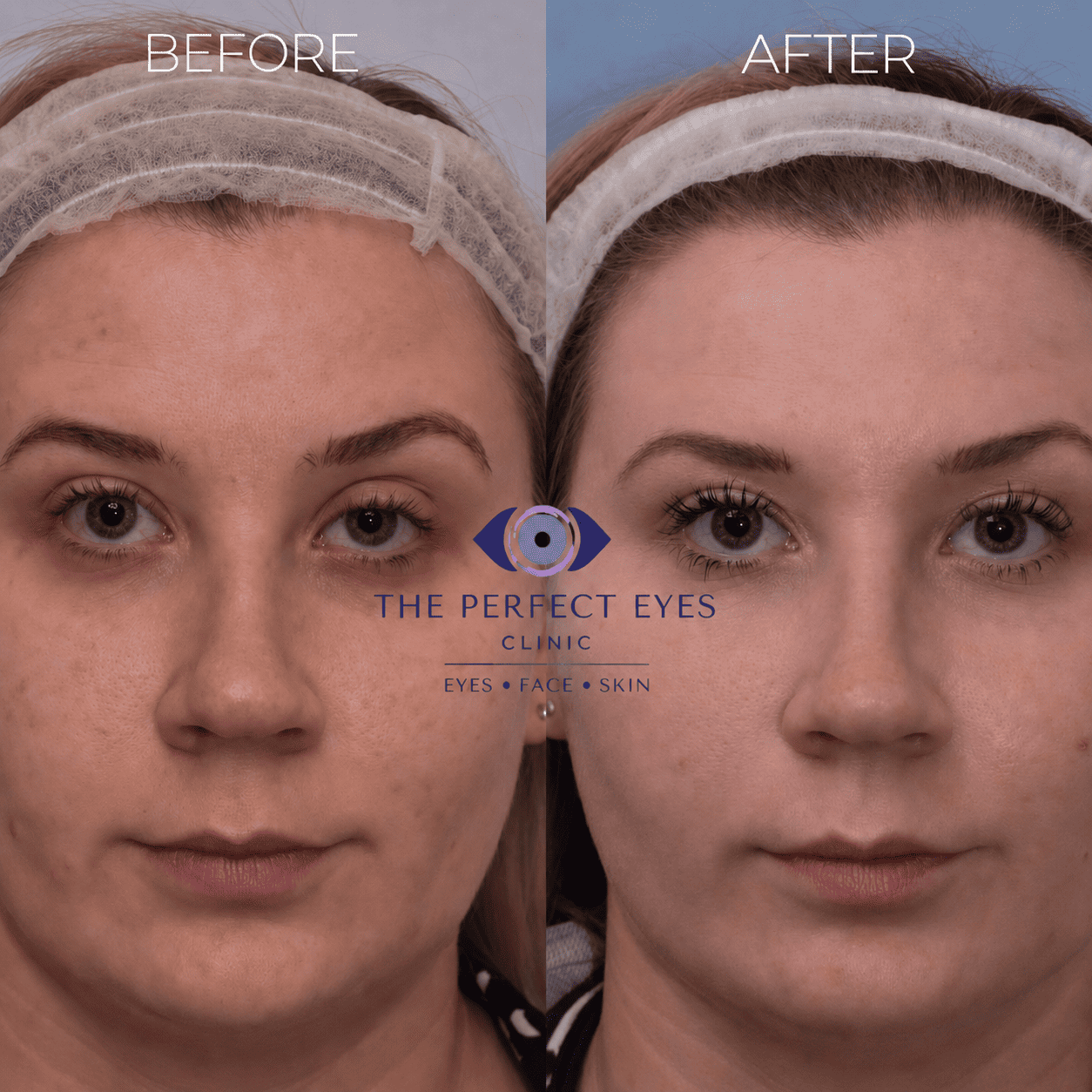 Ptosis surgery before and after, case 16, by Dr Sabrina Shah-Desai