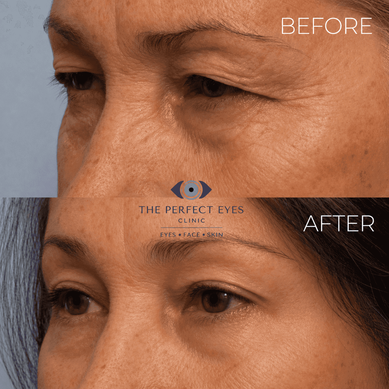 Ptosis surgery before and after, case 21, by Dr Sabrina Shah-Desai