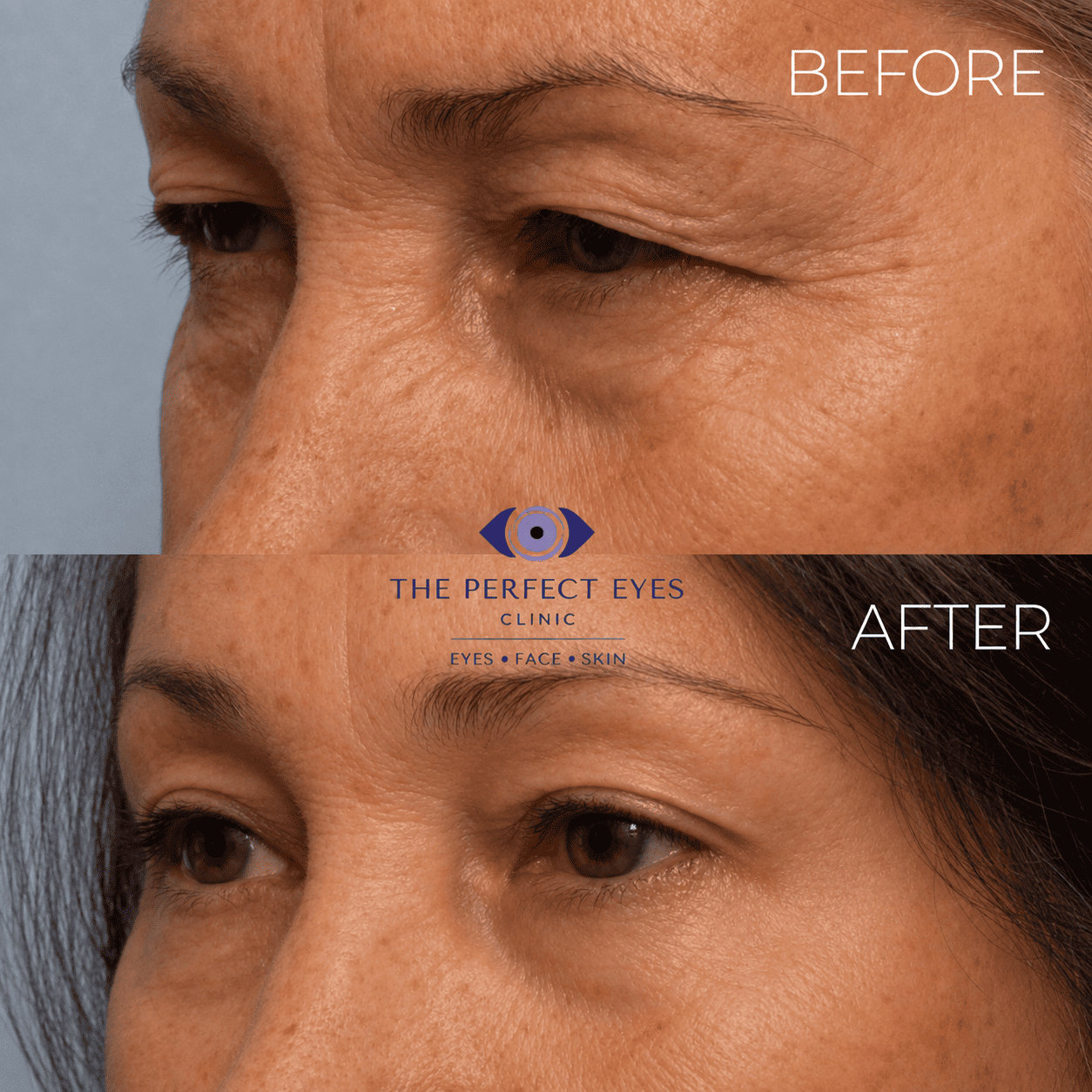 Ptosis surgery before and after, case 21, by Dr Sabrina Shah-Desai