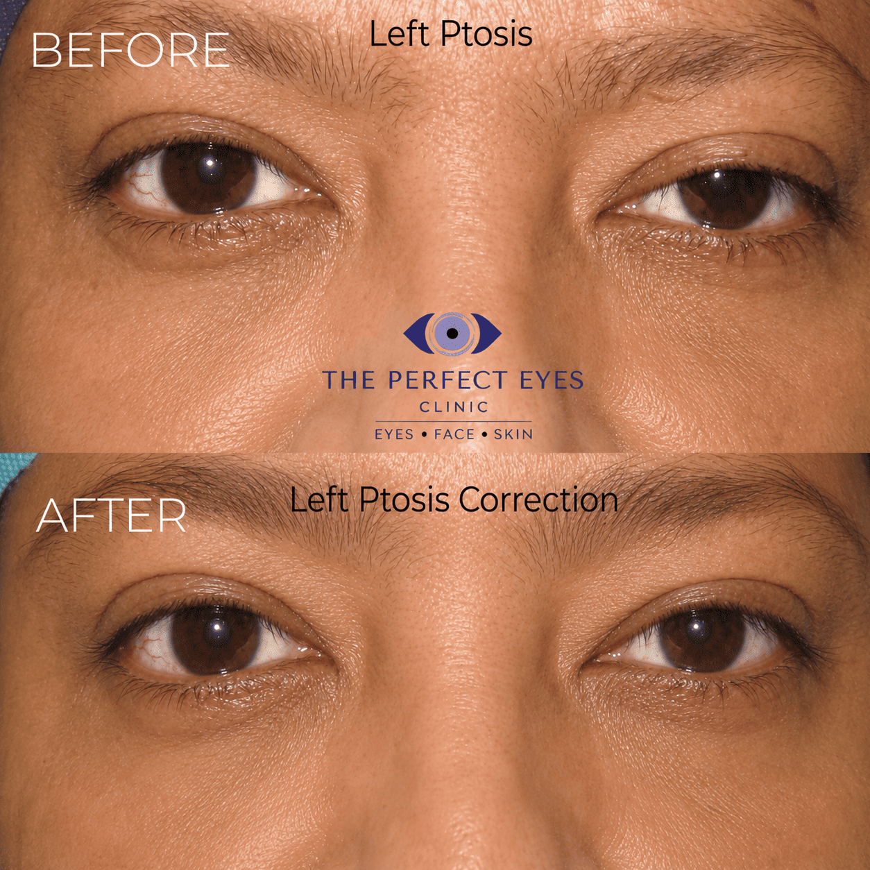 Ptosis surgery before and after, case 3, by Dr Sabrina Shah-Desai