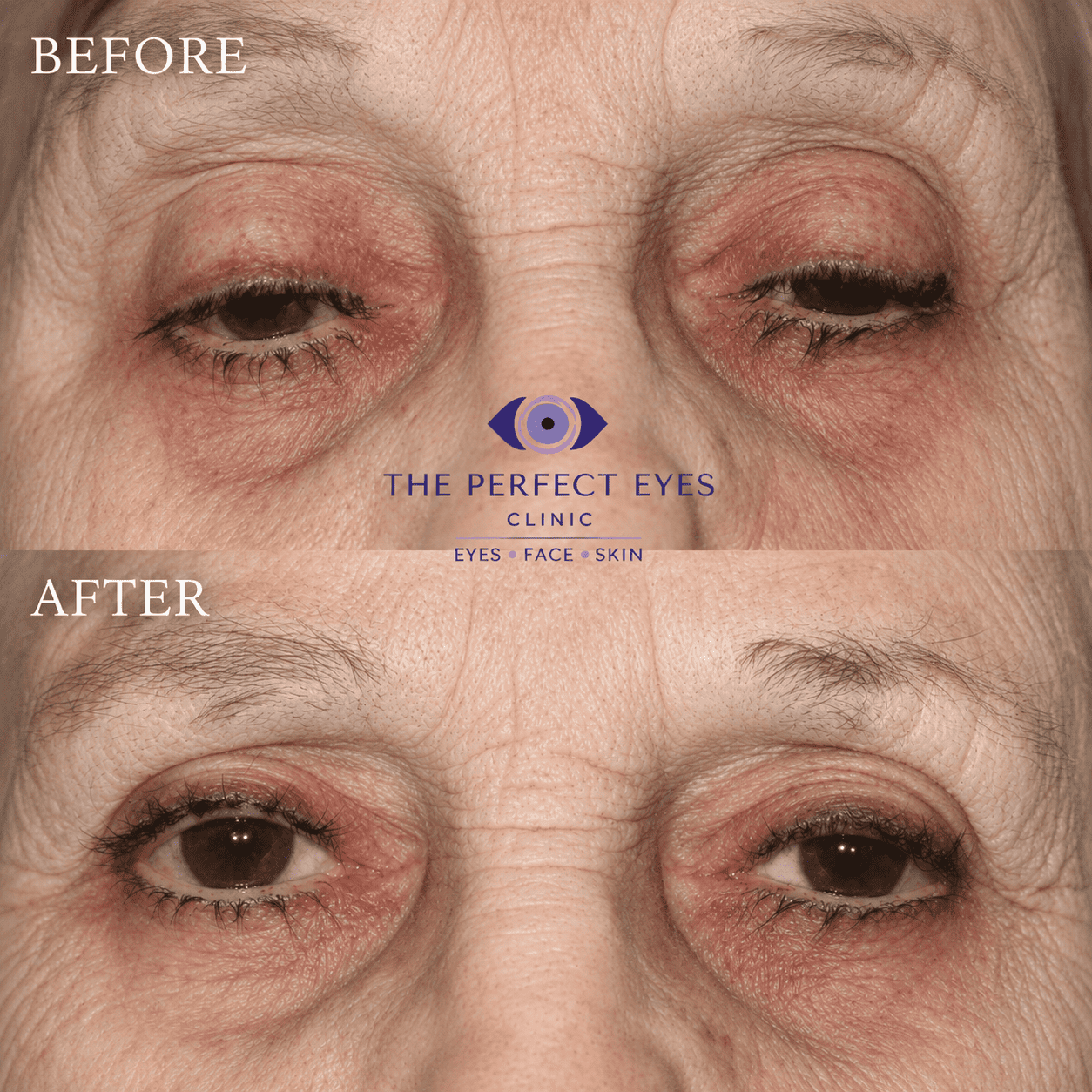 Ptosis surgery before and after, case 5, by Dr Sabrina Shah-Desai