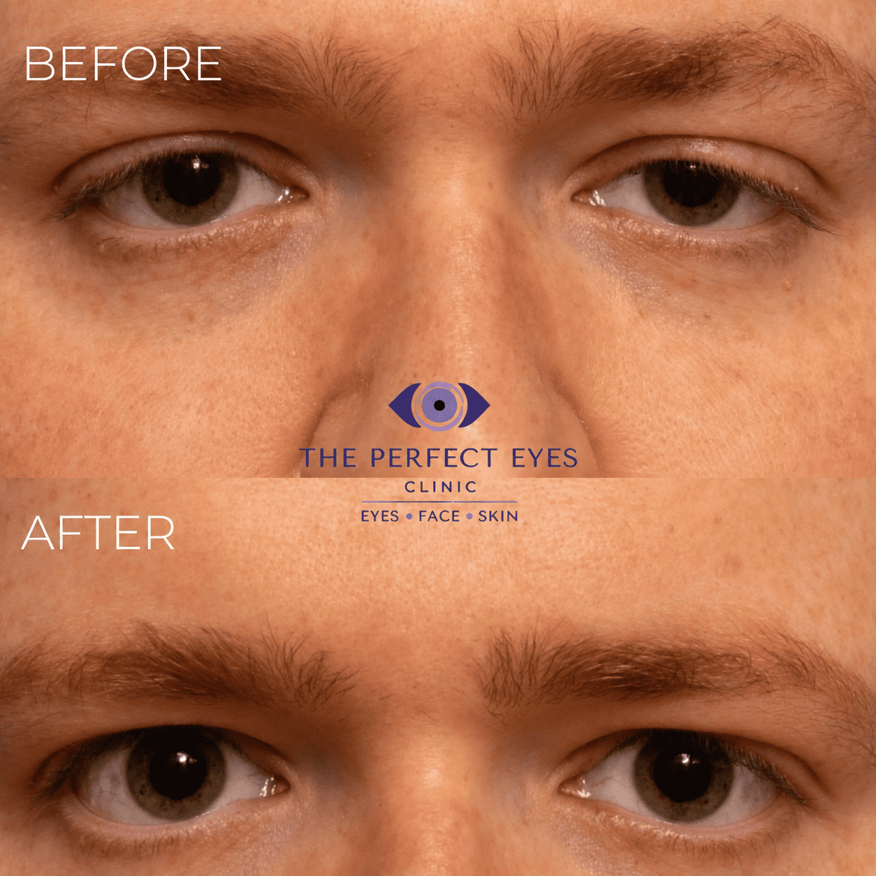 Ptosis surgery before and after, case 6, by Dr Sabrina Shah-Desai