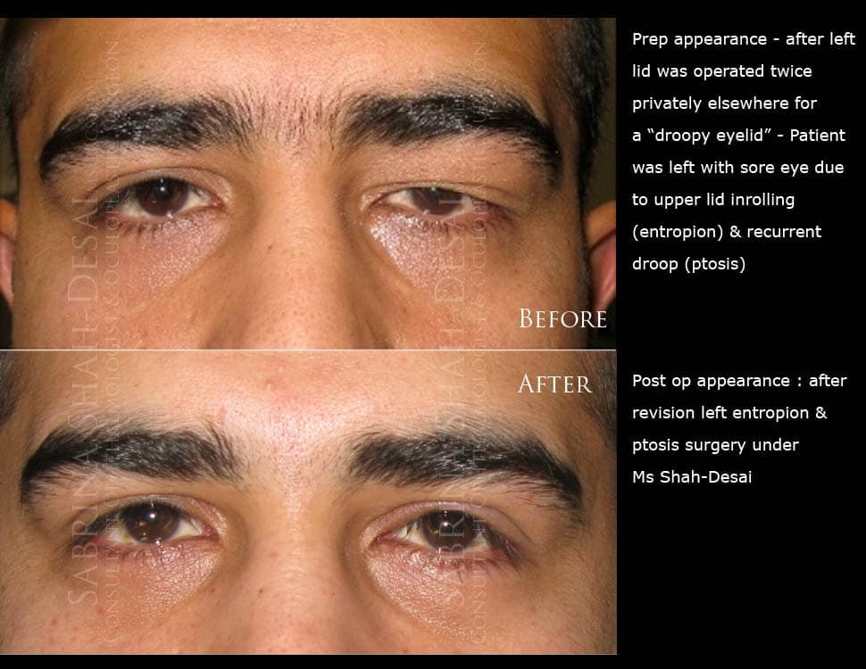 Case study for revision droopy eyelid (ptosis) surgery