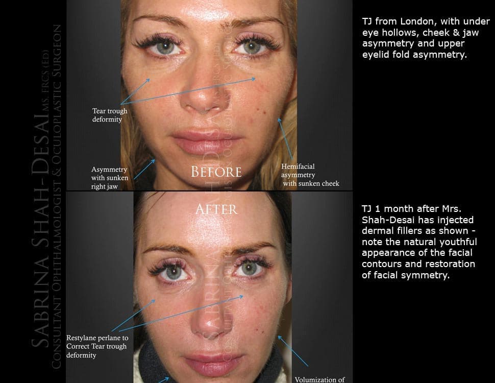 Case Study : Dermal Filler (Liquid Face Lift)