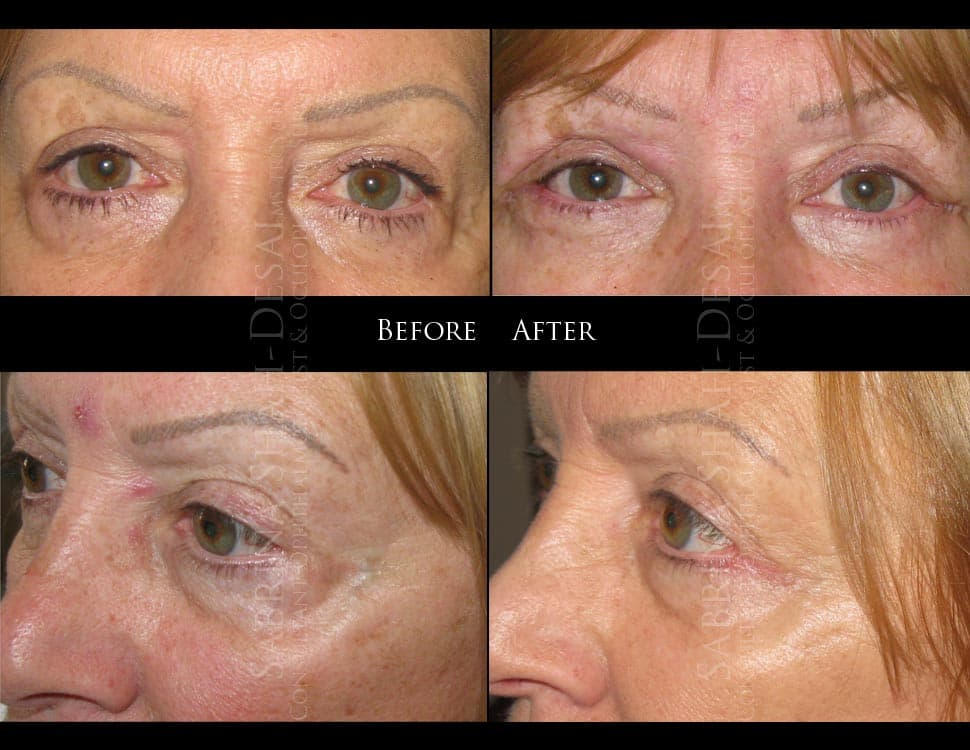 Case Study : Revision Eye Bag Surgery