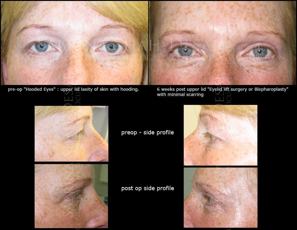 Case Study : Surgery for hooded eyelids (blepharoplasty)