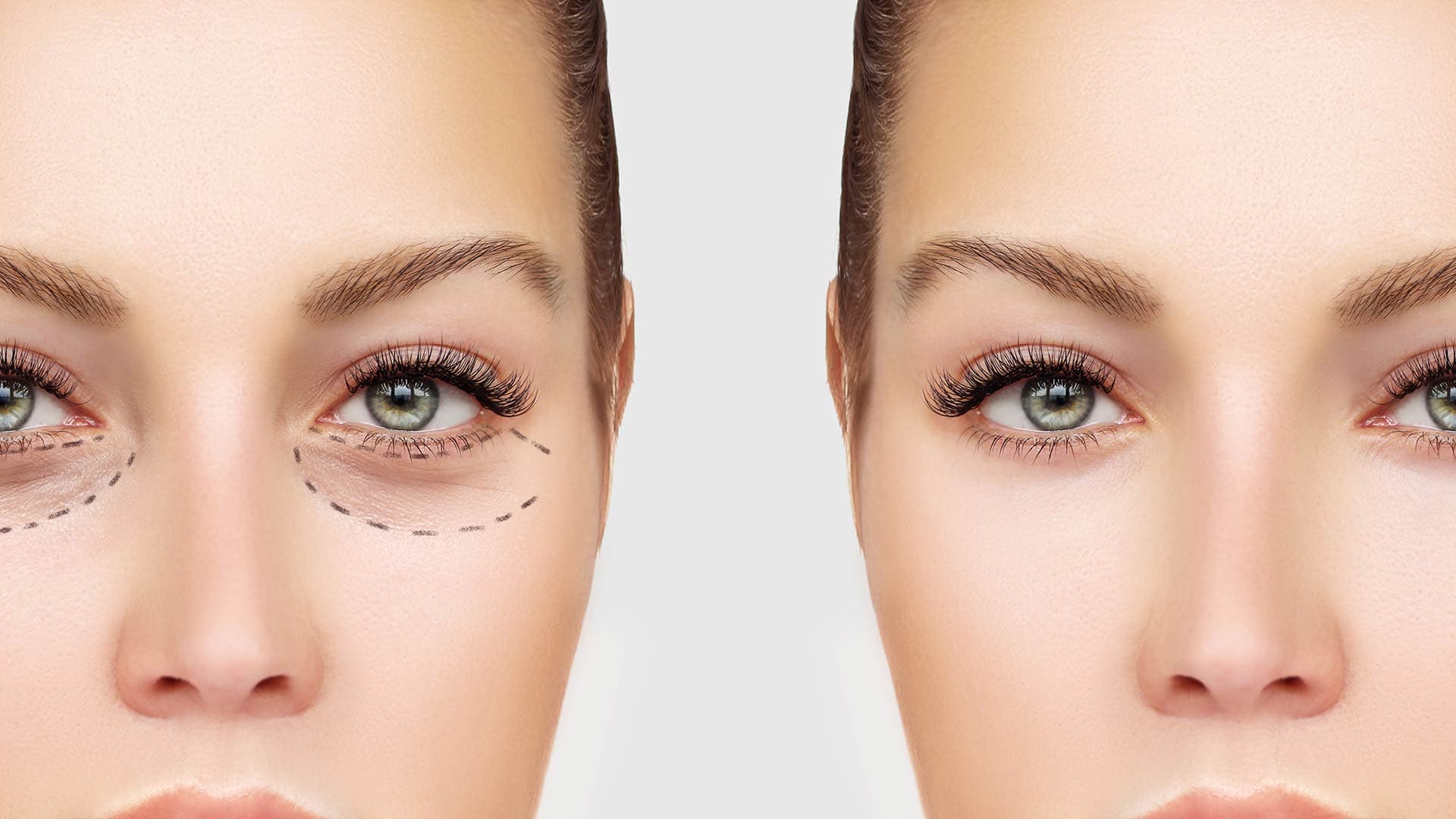 Close-up of the lower eyelid and under-eye area before eye bag surgery