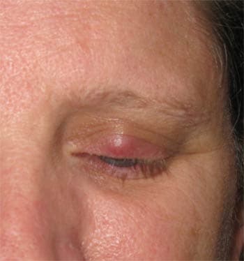 Chalazion removal
