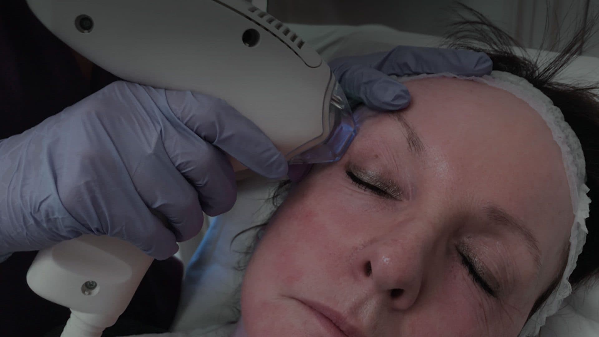 Eyelid Swelling/Migrated Fillers & Hyaluronidase Dissolving illustration