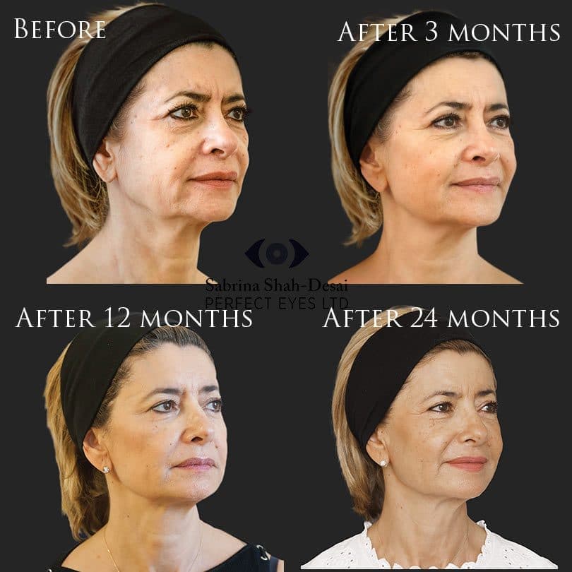 Biostimulation before and after, a patient of Dr Sabrina Shah-Desai