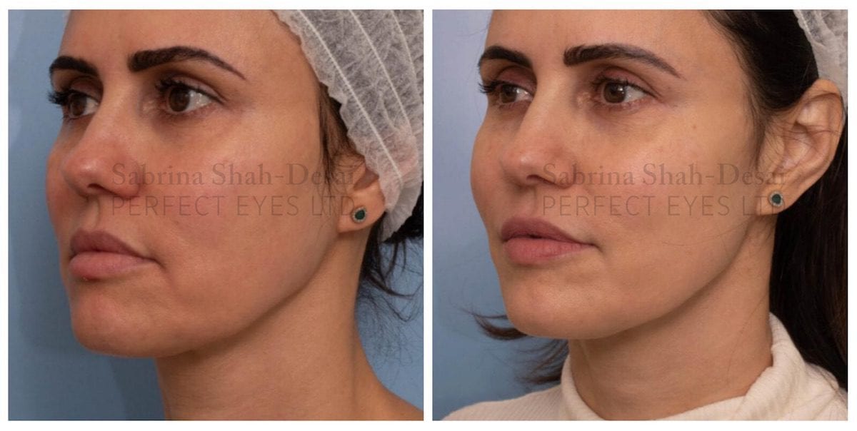 Silhoutte Soft before and after, a patient of Dr Sabrina Shah-Desai