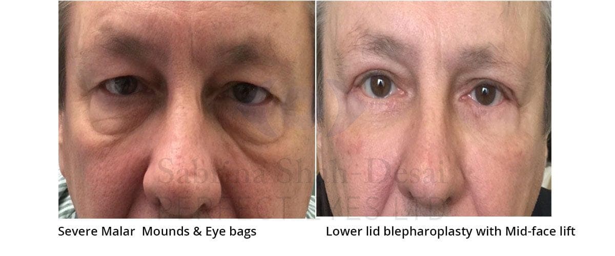 Festoons, Malar Bags and Extended Blepharoplasty vs Endolift before and after, a patient of Dr Sabrina Shah-Desai