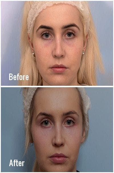 Polynucleotides For Under Eye Rejuvenation before and after, a patient of Dr Sabrina Shah-Desai