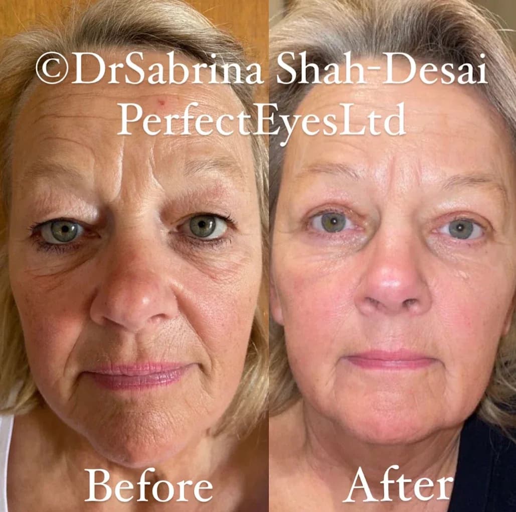 UltraClear Laser before and after - case 11