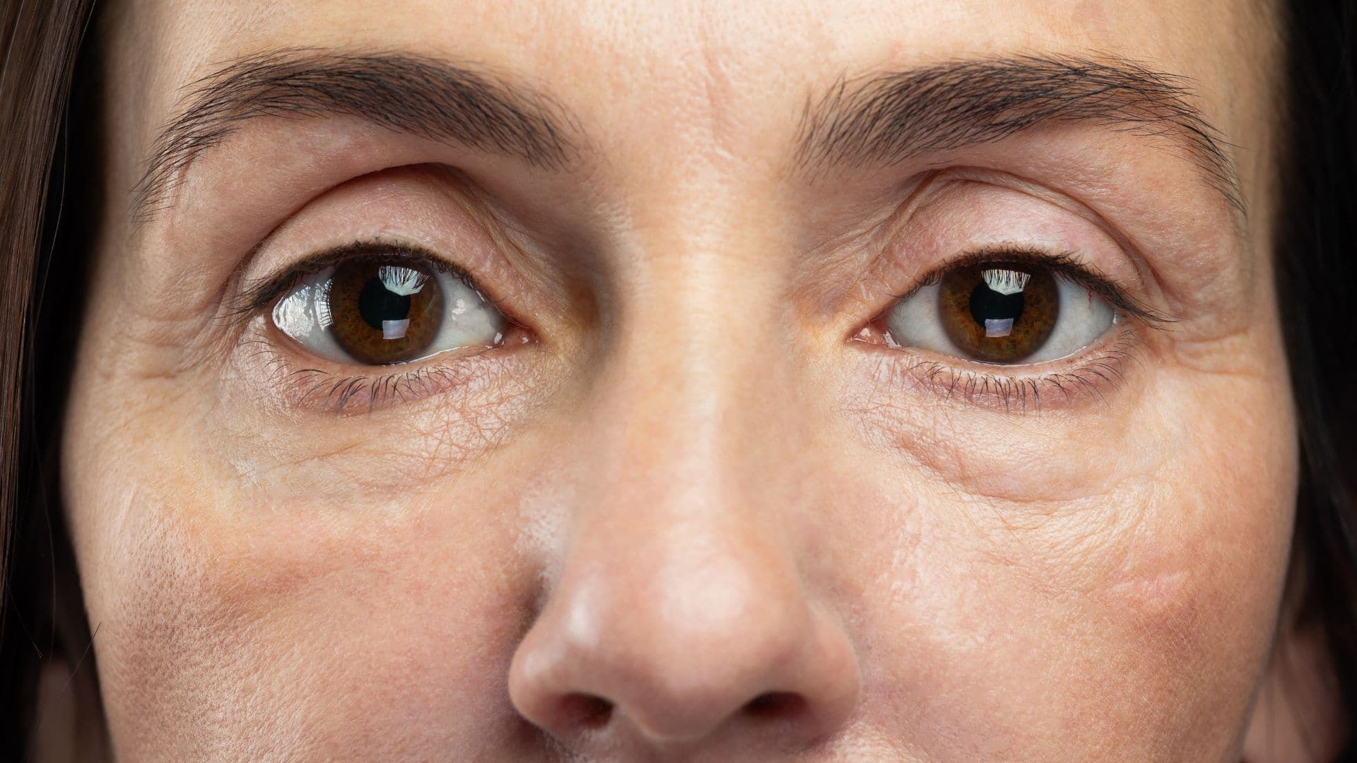 How to Remove Under Eye Bags Permanently