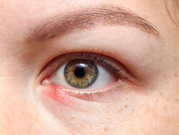 What is a Chalazion?